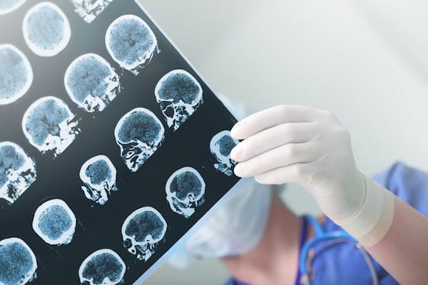 Morbo di Alzheimer: il nuovo bando da 300 mila euro dell’Associazione “Airalzh” per la ricerca sulla malattia