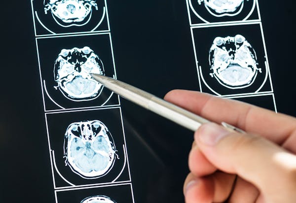 Alzheimer: un farmaco studiato per ritardare la progressione dell’Alzheimer è stato approvato dalla FDA