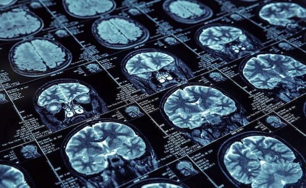 Parkinson: gli ultrasuoni mirati possono ridurre i sintomi