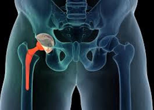 Sostituzione dell'anca: un farmaco per l'osteoporosi può prevenire fino al 50 per cento delle operazioni
