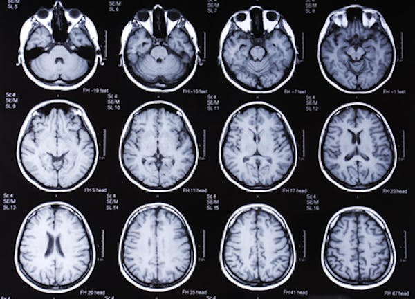 Riconoscere l’Alzheimer prima della comparsa dei sintomi grazie all’Intelligenza Artificiale