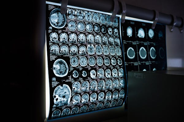 Nuovo metodo consentirebbe di diagnosticare precocemente l'Alzheimer attraverso risonanza magnetica 