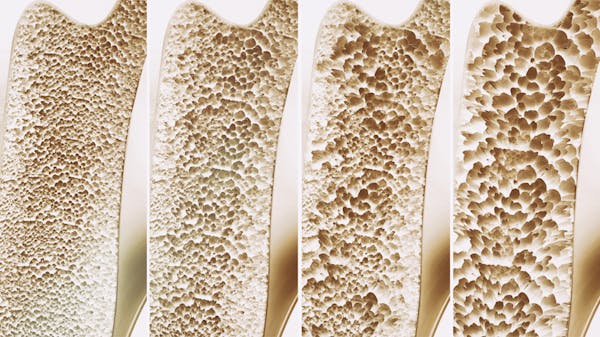 Osteoporosi e fragilità ossea: dalla Cina, un nuovo sistema per la diagnosi precoce e la prevenzione