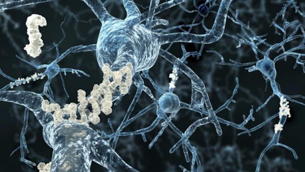 Una proteina contro il Parkinson: lo studio degli scienziati in Israele