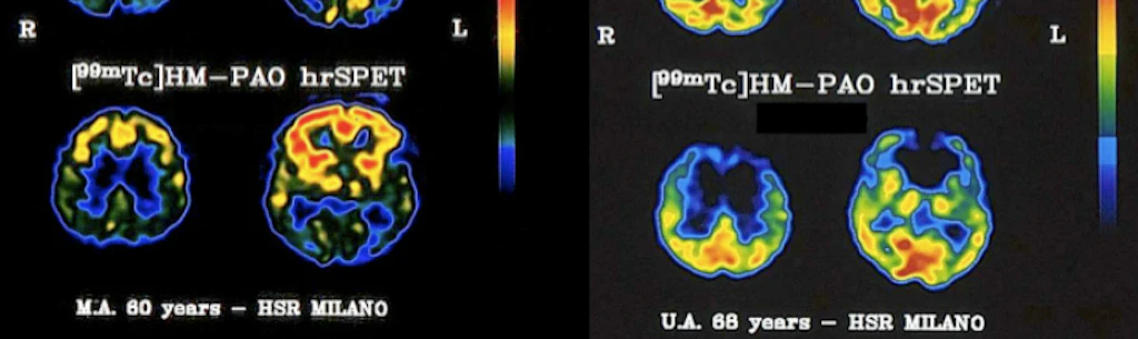 3 over85 su 10 soffrono di demenza senile