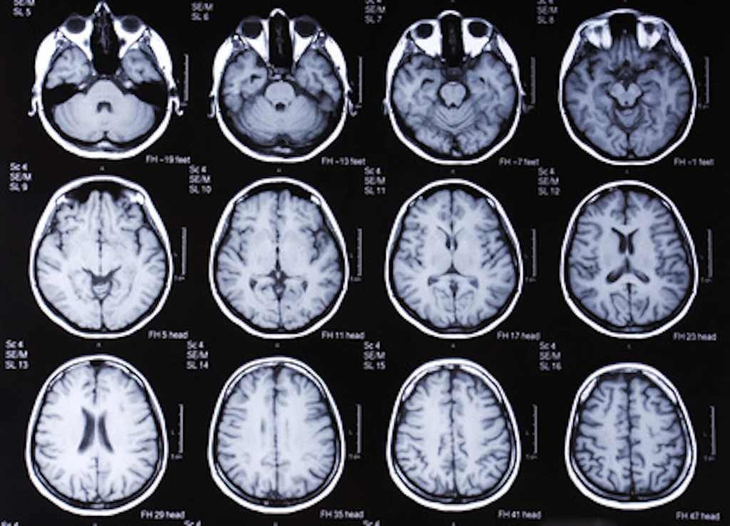 Riconoscere l’Alzheimer prima della comparsa dei sintomi grazie all’Intelligenza Artificiale