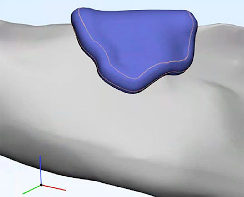 OSTEOCAR3D: Il bioprinting offre una nuova metodologia per produrre prodotti sanitari personalizzati